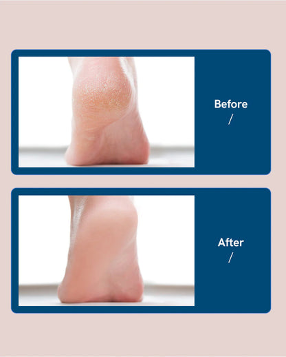 Venilya™ - Foot Callus Remover